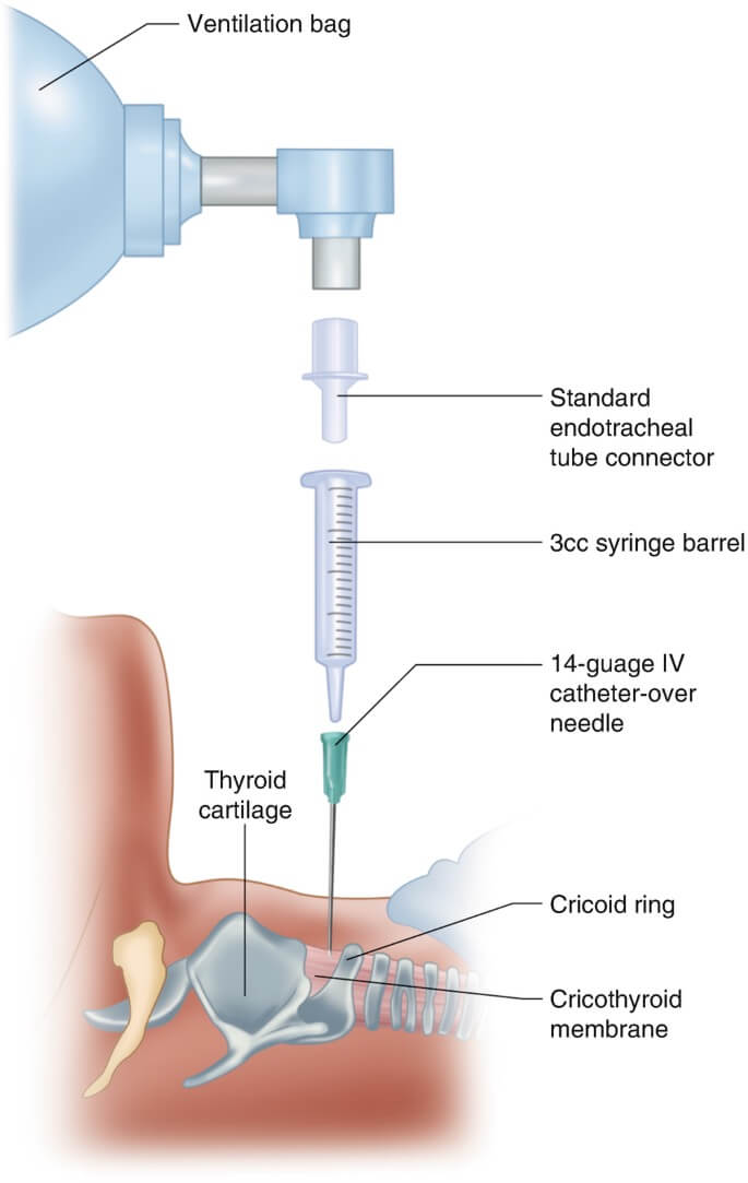 Pediatric transtracheal jet ventilation setup showing wall O2 source, regulator, manual jet ventilator, and angiocatheter connected via a 3.0 ETT adapter.
